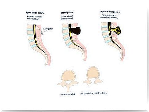 Treatment of Spina Bifida