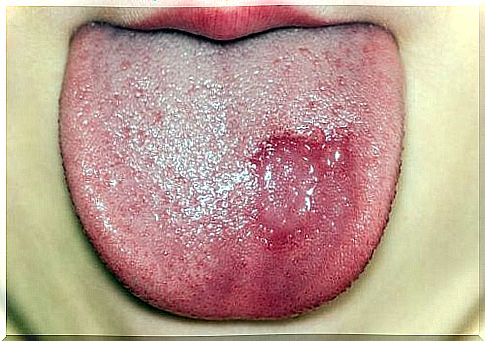 Geographical tongue in children: symptoms and treatment