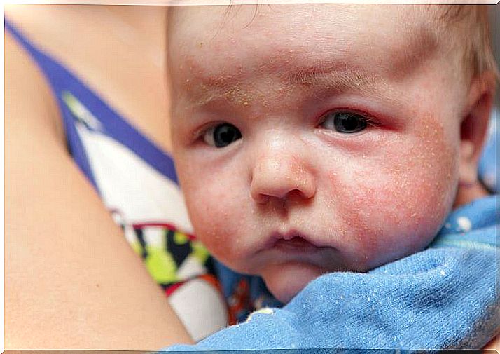 How to fight rash in babies