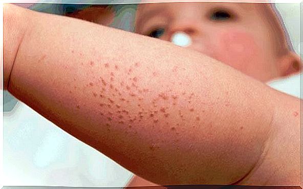 Rash in babies - rash