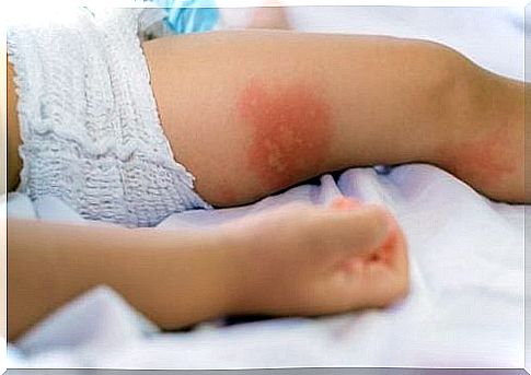 How to prevent and treat diaper rash