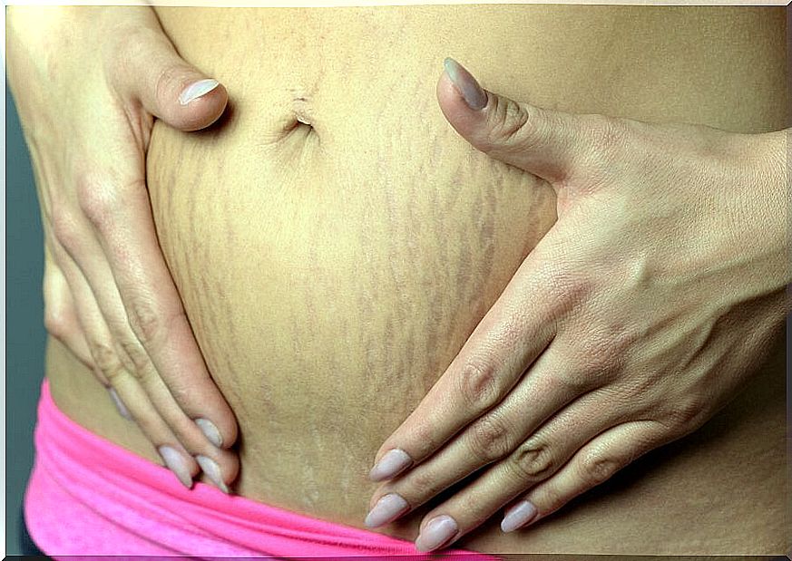 Pregnancy: avoid stretch marks