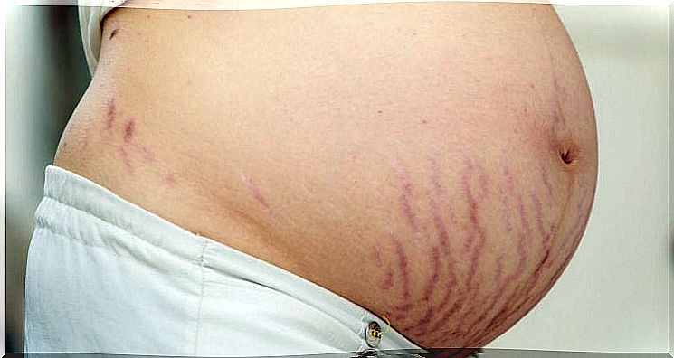 Avoid stretch marks