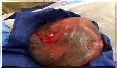 Child with an intact amniotic sac